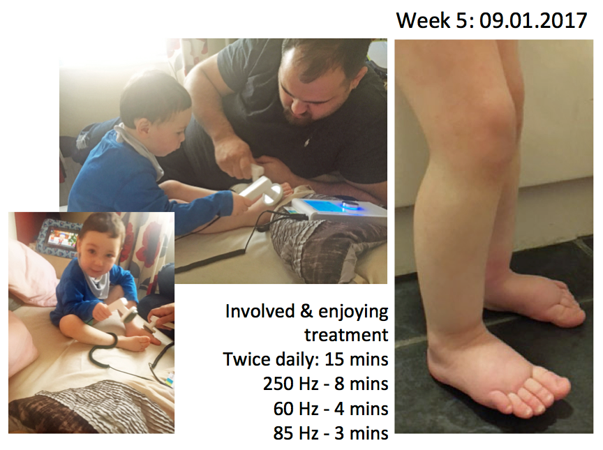 Life with Lincoln Now Six - Born with Multiple Genetic Disorders (including Congenital Lymphoedema): Self-Managing with Deep Oscillation Three Years On